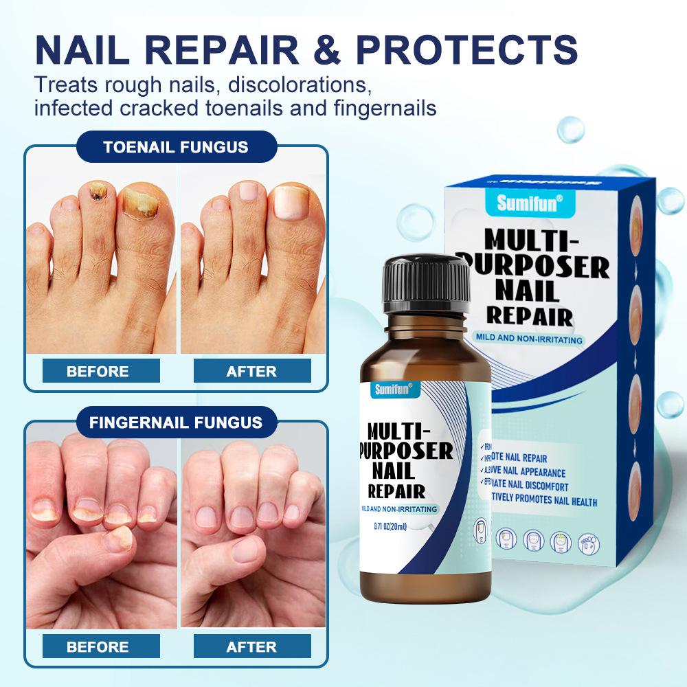 Graue Nagelpaste, verdickte, glänzende Nägel, Reparatur grauer Nägel, saubere und weiche Nagelpaste, Pflege bei Hand-, Fuß- und Zehennagelkaries 20Ml